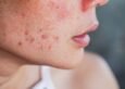 How Acne Facial Treatments Help Clear Skin