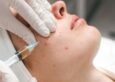 Hormonal Pimple Treatment Price Malaysia
