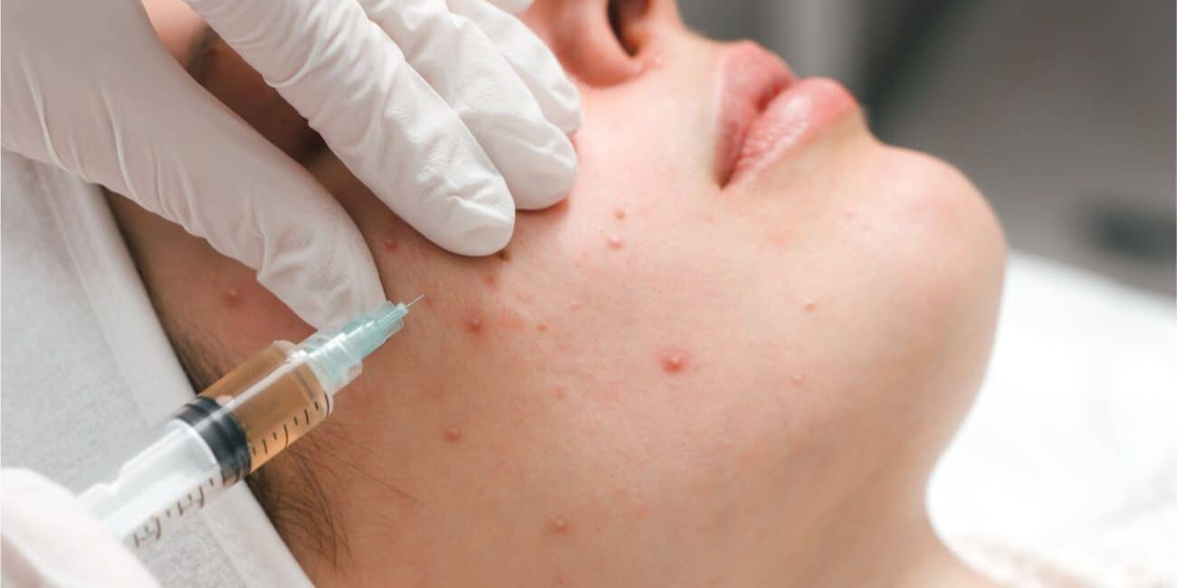 Hormonal Pimple Treatment Price Malaysia