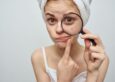 Best Acne Spot Treatment for Sensitive Skin