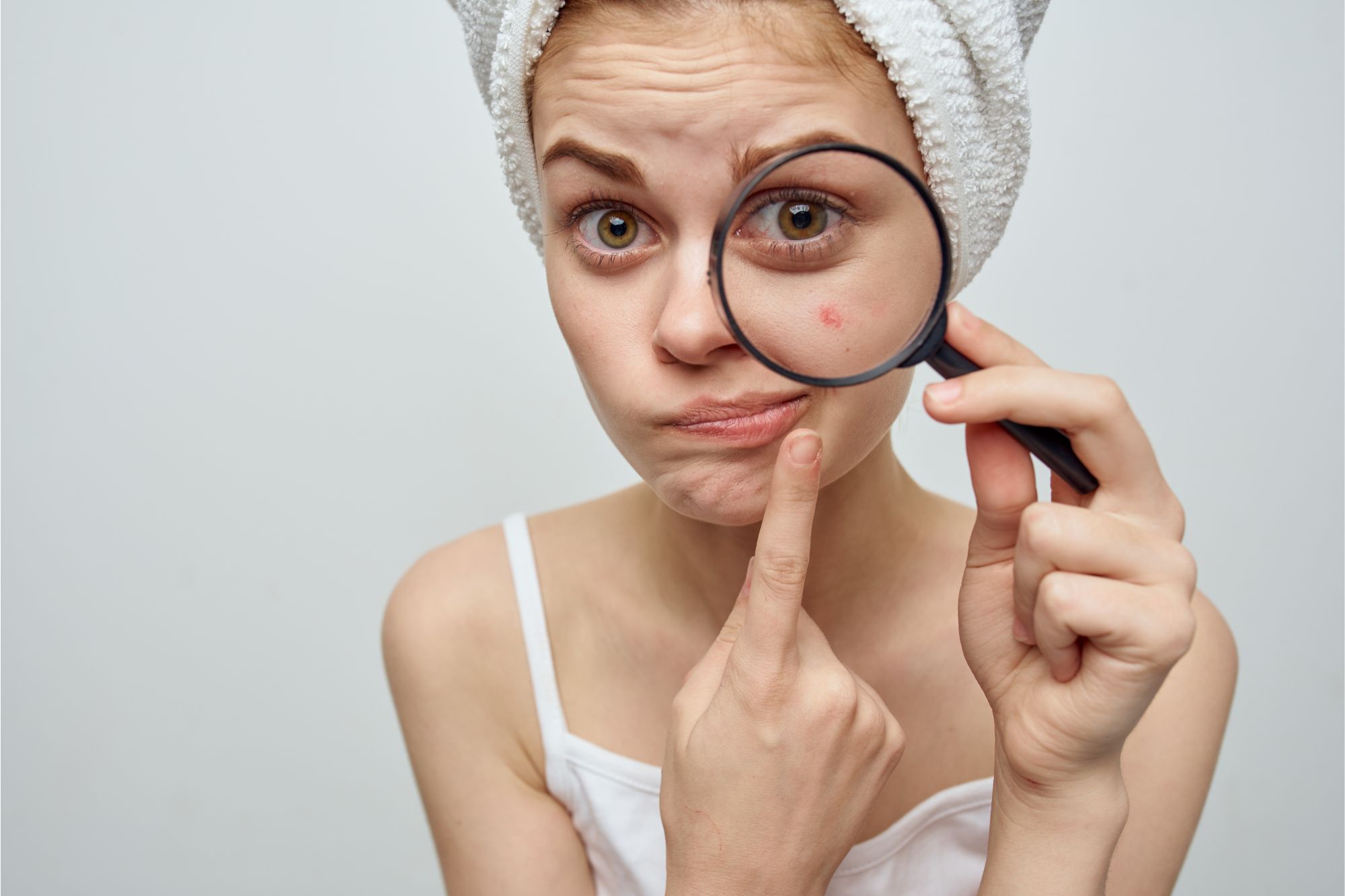 Best Acne Spot Treatment for Sensitive Skin