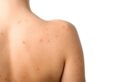 Back Acne Treatment Guide Malaysia