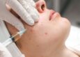 Pimple Scar Treatment Price Malaysia