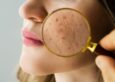 Acne Types, Causes, and Prevention