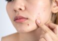 Types of Acne: Causes, Symptoms & Best Treatment Options